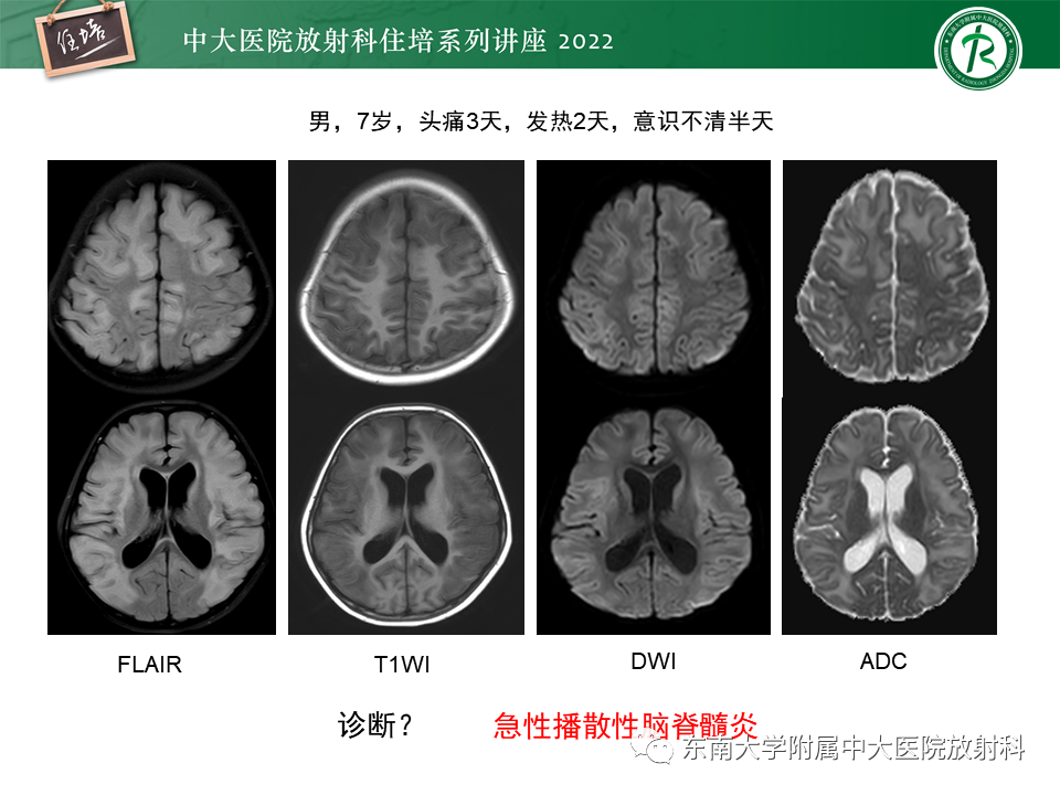 影像PPT - 【PPT】皮层下U形纤维受累常见病变-18