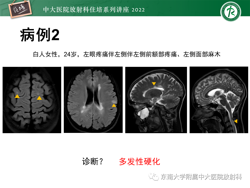 影像PPT - 【PPT】皮层下U形纤维受累常见病变-20