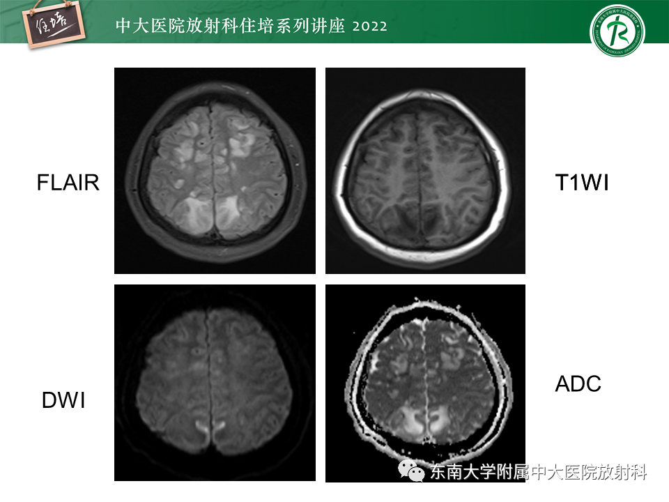 影像PPT - 【PPT】皮层下U形纤维受累常见病变-25