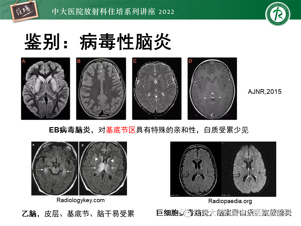 影像PPT - 【PPT】皮层下U形纤维受累常见病变-19