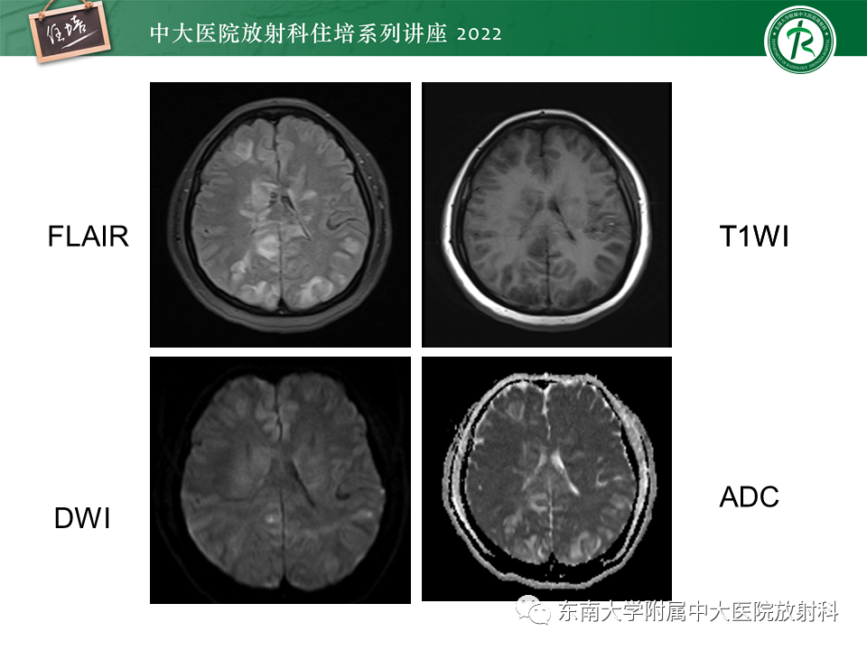 影像PPT - 【PPT】皮层下U形纤维受累常见病变-26