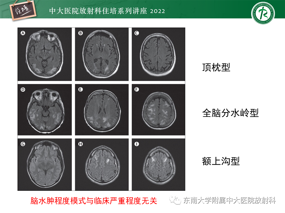 影像PPT - 【PPT】皮层下U形纤维受累常见病变-29