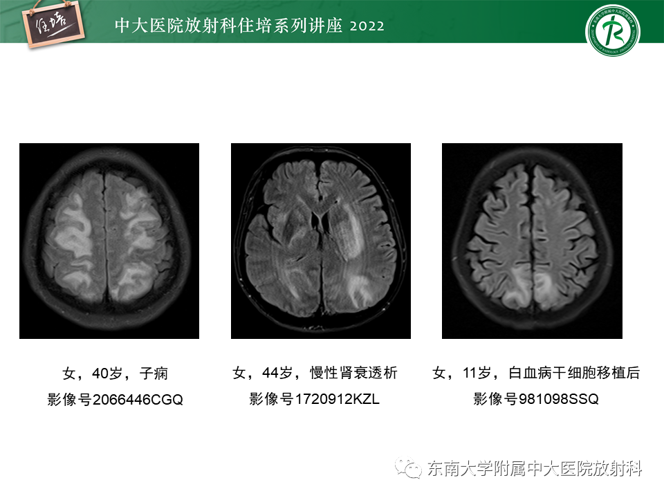 影像PPT - 【PPT】皮层下U形纤维受累常见病变-30