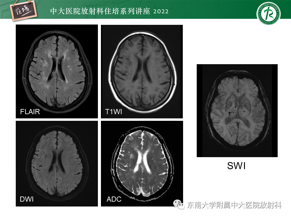 影像PPT - 【PPT】皮层下U形纤维受累常见病变-32
