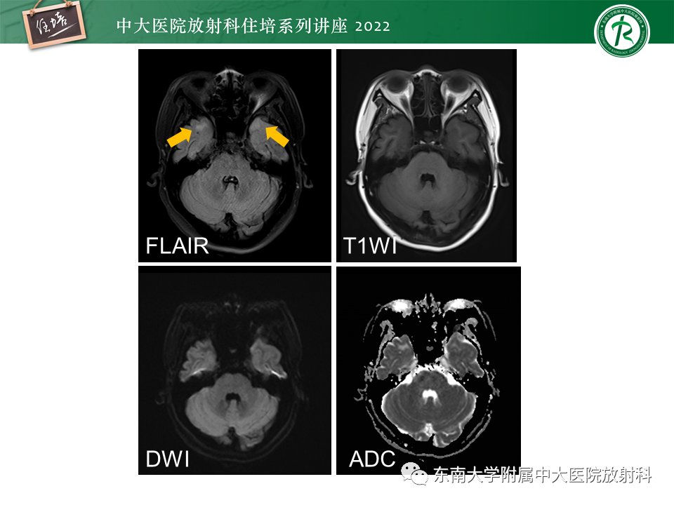影像PPT - 【PPT】皮层下U形纤维受累常见病变-33