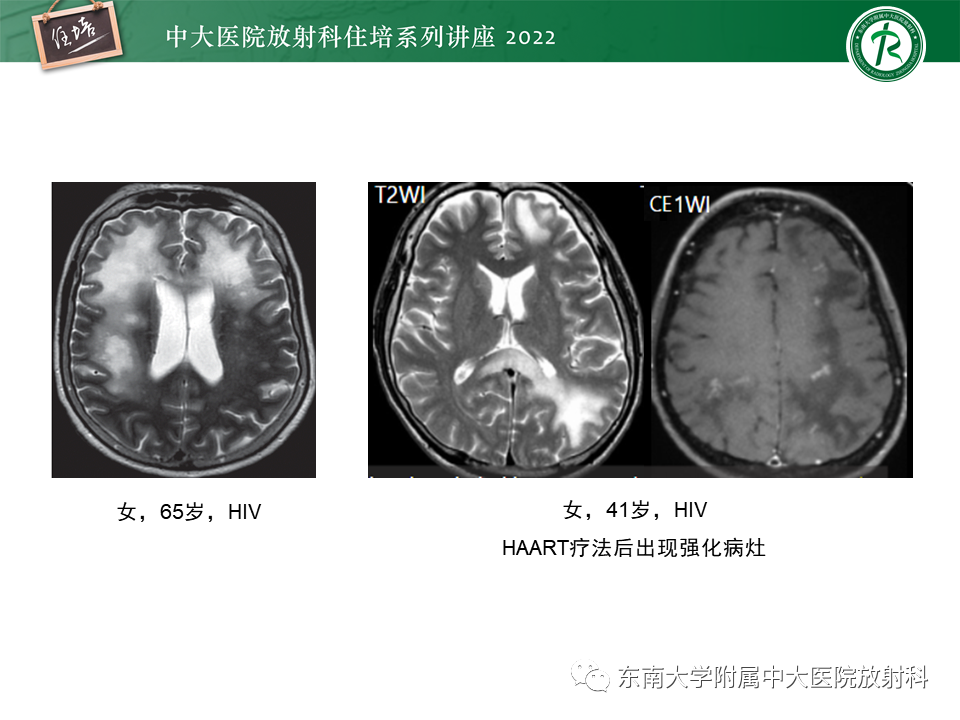 影像PPT - 【PPT】皮层下U形纤维受累常见病变-36