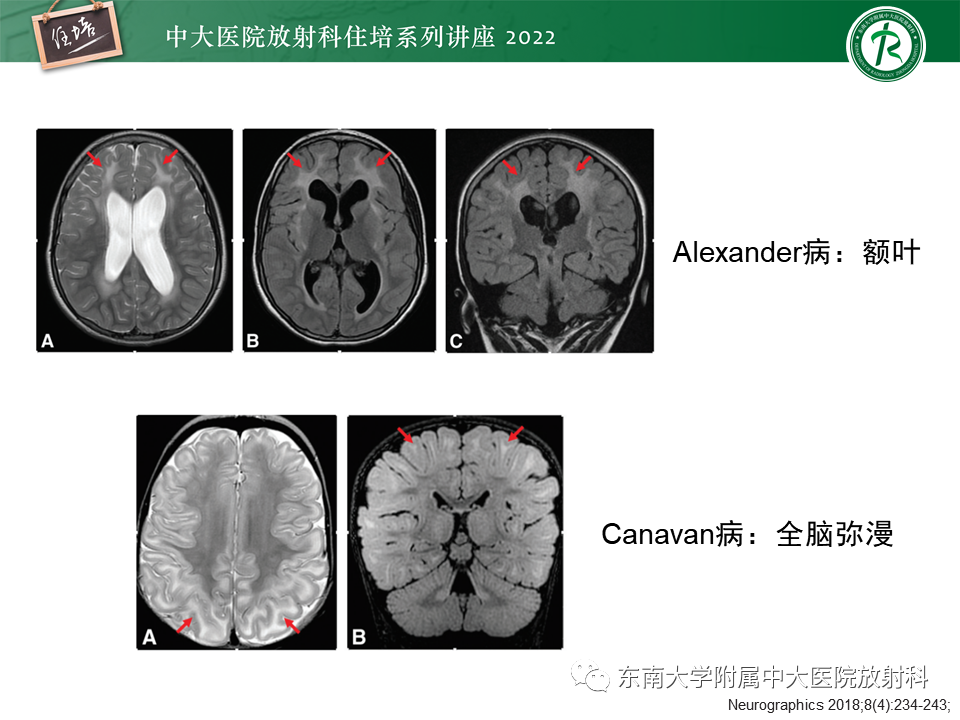 影像PPT - 【PPT】皮层下U形纤维受累常见病变-39