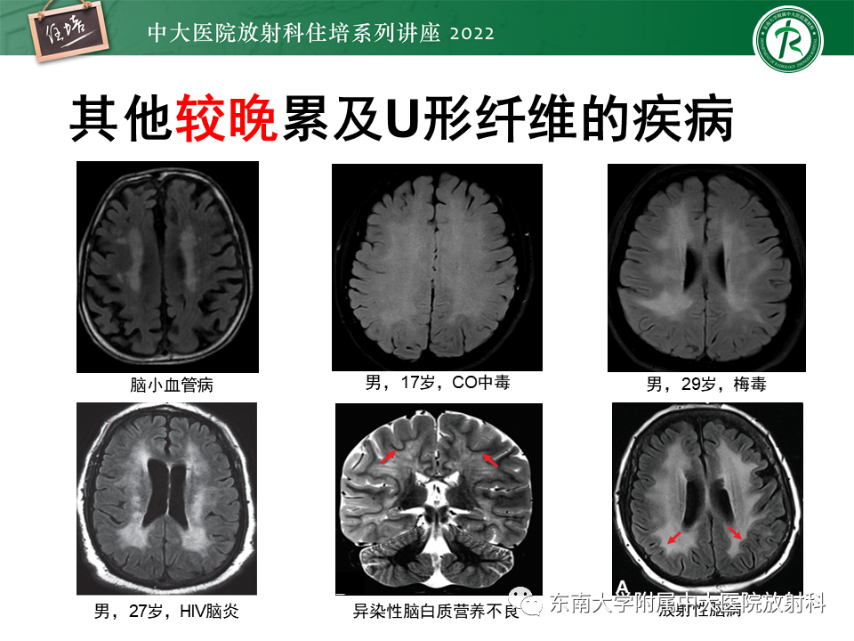 影像PPT - 【PPT】皮层下U形纤维受累常见病变-40