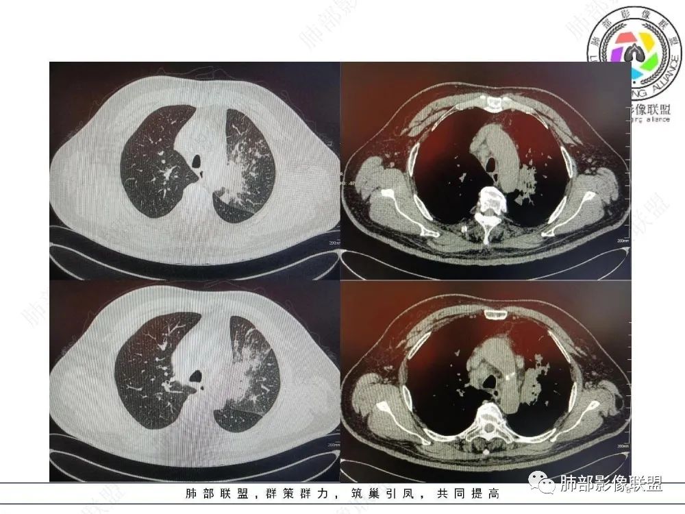 影像PPT - 【病例】肺部这样的片状影,你是否能一锤定音?-5 影像PPT - 【病例】肺部这样的片状影,你是否能一锤定音?-5