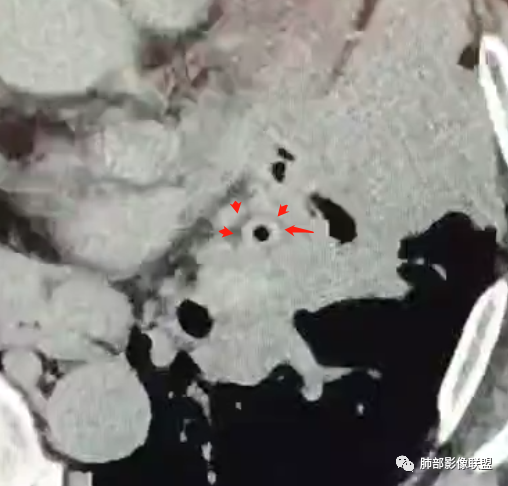 影像PPT - 【病例】肺部这样的片状影,你是否能一锤定音?-18 影像PPT - 【病例】肺部这样的片状影,你是否能一锤定音?-18