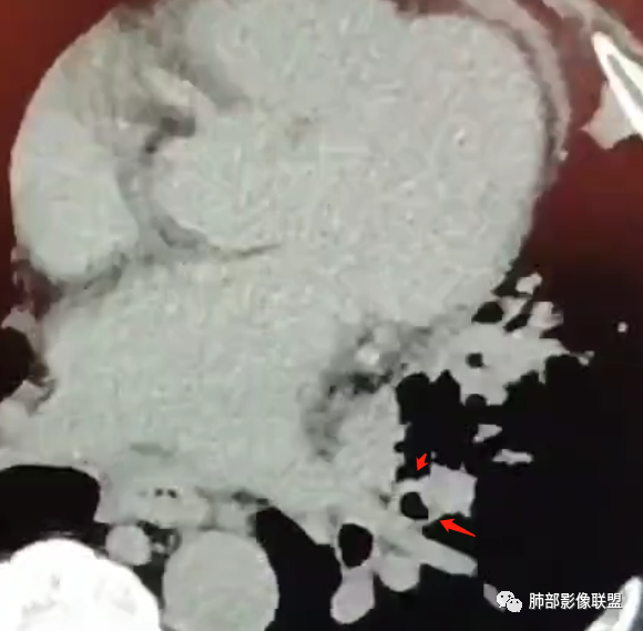 影像PPT - 【病例】肺部这样的片状影,你是否能一锤定音?-19 影像PPT - 【病例】肺部这样的片状影,你是否能一锤定音?-19