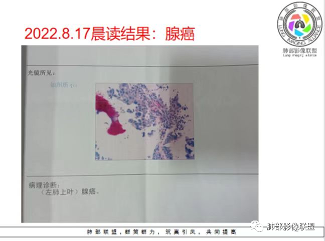 影像PPT - 【病例】肺部这样的片状影,你是否能一锤定音?-28 影像PPT - 【病例】肺部这样的片状影,你是否能一锤定音?-28