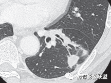 影像PPT - 【病例】肺部这样的片状影,你是否能一锤定音?-29 影像PPT - 【病例】肺部这样的片状影,你是否能一锤定音?-29
