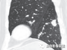 影像PPT - 【病例】肺部这样的片状影,你是否能一锤定音?-30 影像PPT - 【病例】肺部这样的片状影,你是否能一锤定音?-30
