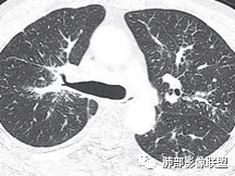 影像PPT - 【病例】肺部这样的片状影,你是否能一锤定音?-31 影像PPT - 【病例】肺部这样的片状影,你是否能一锤定音?-31