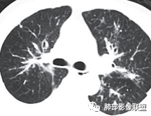 影像PPT - 【病例】肺部这样的片状影,你是否能一锤定音?-33 影像PPT - 【病例】肺部这样的片状影,你是否能一锤定音?-33