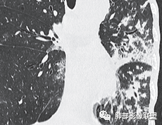 影像PPT - 【病例】肺部这样的片状影,你是否能一锤定音?-34 影像PPT - 【病例】肺部这样的片状影,你是否能一锤定音?-34