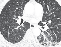 影像PPT - 【病例】肺部这样的片状影,你是否能一锤定音?-32 影像PPT - 【病例】肺部这样的片状影,你是否能一锤定音?-32
