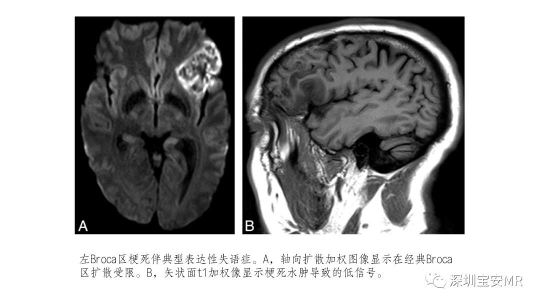 影像PPT - 【PPT】脑功能成像解剖-21