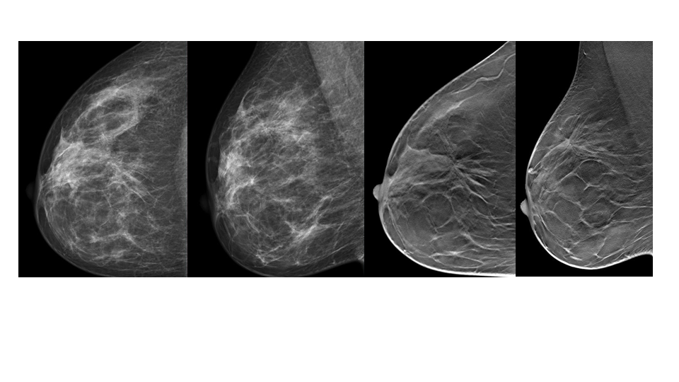 影像PPT - 【病例】纤维囊性乳腺病伴纤维腺瘤形成 VS 乳腺增生病并间质硬化-6