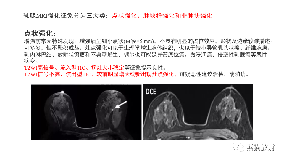 影像PPT - 【病例】纤维囊性乳腺病伴纤维腺瘤形成 VS 乳腺增生病并间质硬化-15