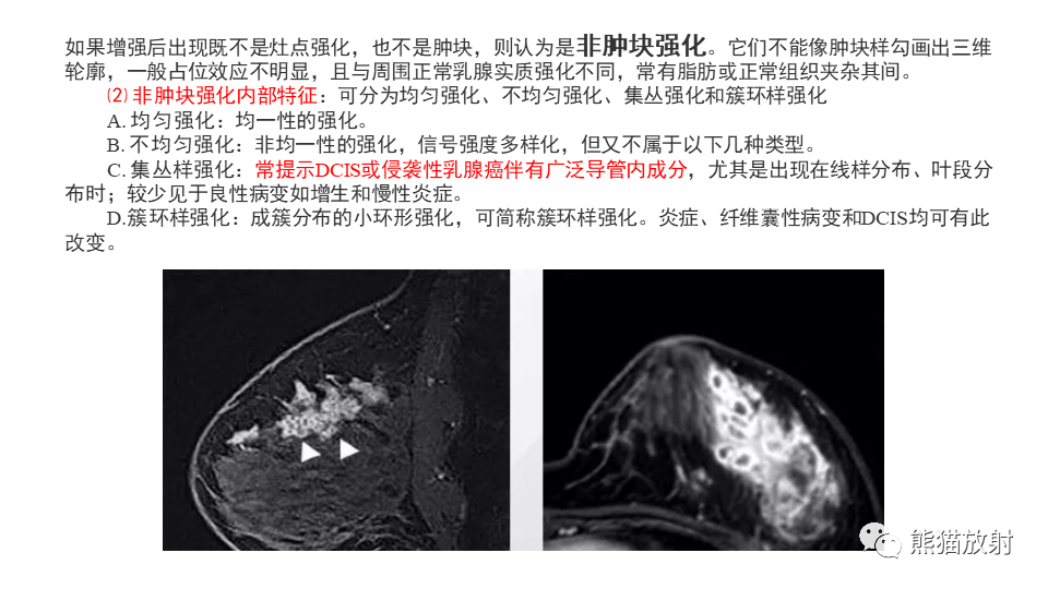 影像PPT - 【病例】纤维囊性乳腺病伴纤维腺瘤形成 VS 乳腺增生病并间质硬化-19