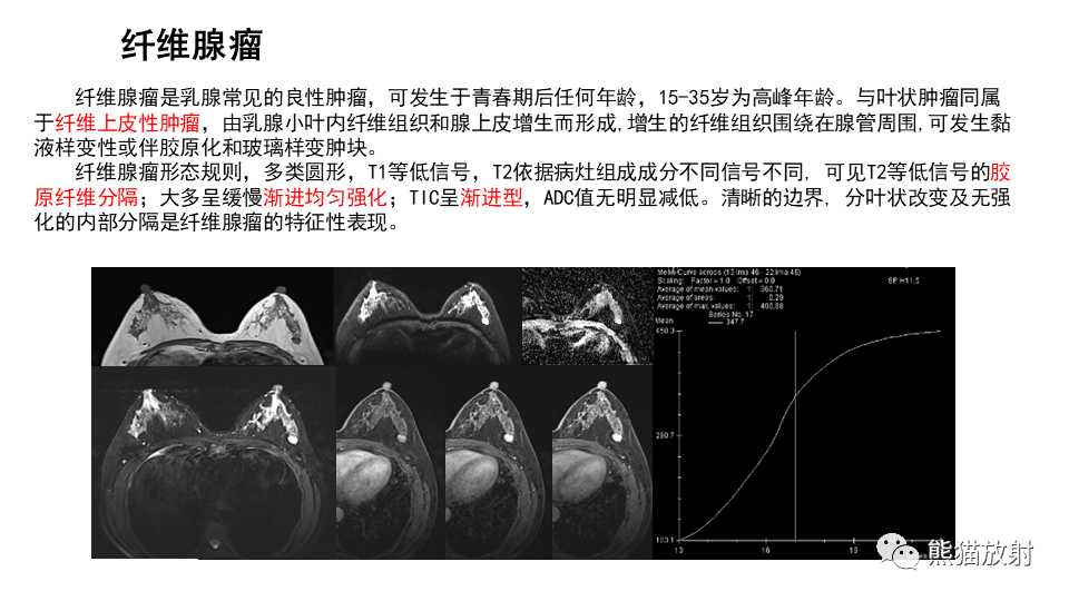 影像PPT - 【病例】纤维囊性乳腺病伴纤维腺瘤形成 VS 乳腺增生病并间质硬化-25