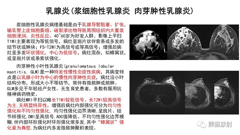 影像PPT - 【病例】纤维囊性乳腺病伴纤维腺瘤形成 VS 乳腺增生病并间质硬化-24