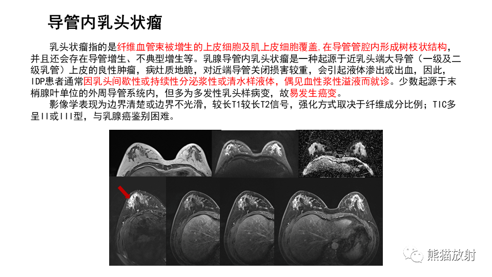 影像PPT - 【病例】纤维囊性乳腺病伴纤维腺瘤形成 VS 乳腺增生病并间质硬化-26