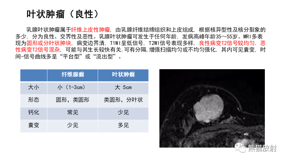 影像PPT - 【病例】纤维囊性乳腺病伴纤维腺瘤形成 VS 乳腺增生病并间质硬化-27