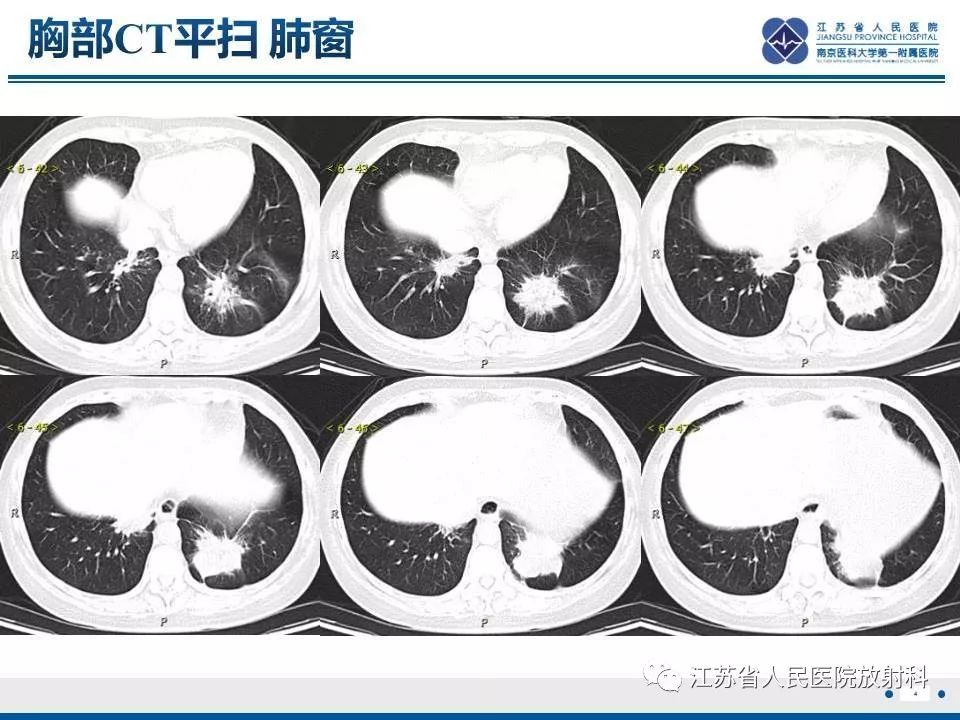 影像PPT - 【PPT】脂质性肺炎-4
