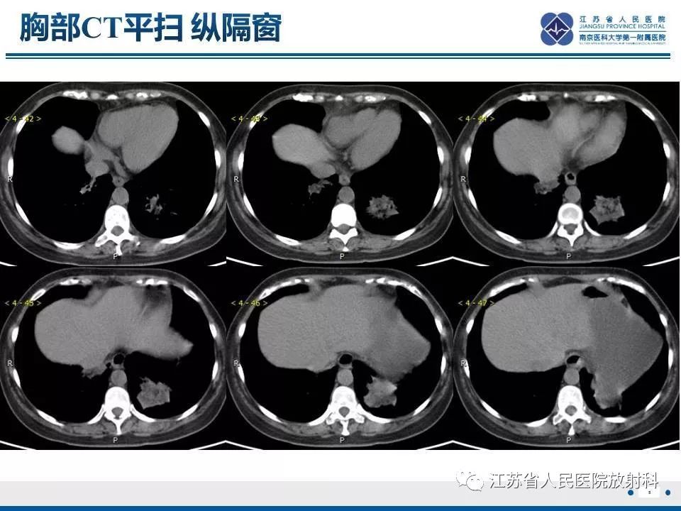 影像PPT - 【PPT】脂质性肺炎-5