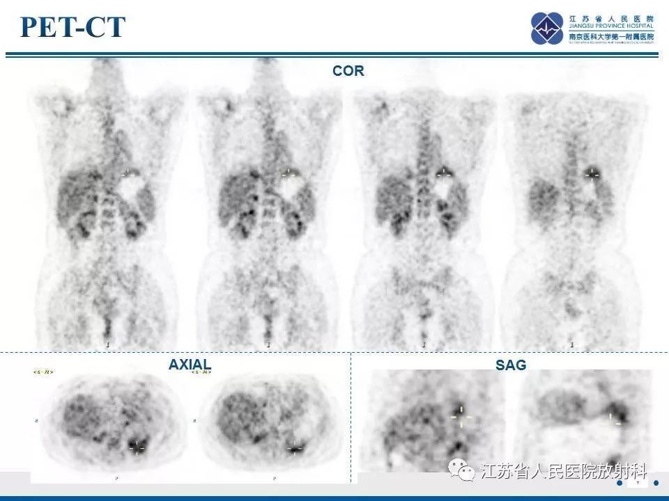影像PPT - 【PPT】脂质性肺炎-7