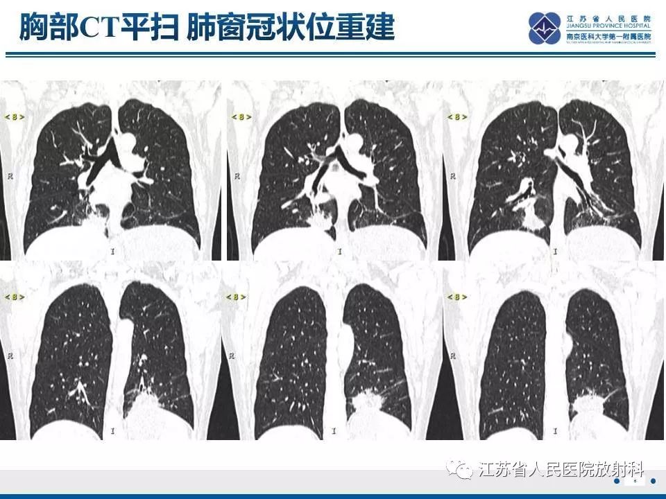 影像PPT - 【PPT】脂质性肺炎-6