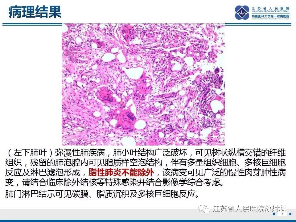 影像PPT - 【PPT】脂质性肺炎-19