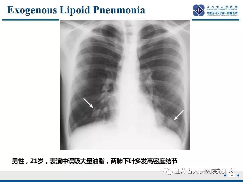 影像PPT - 【PPT】脂质性肺炎-23