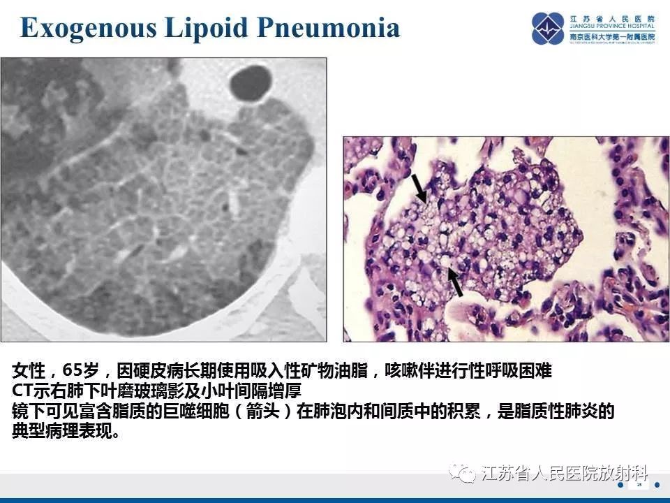 影像PPT - 【PPT】脂质性肺炎-25
