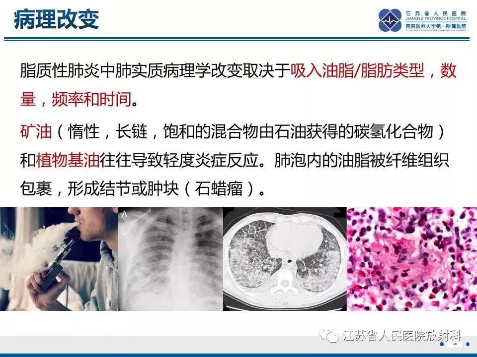 影像PPT - 【PPT】脂质性肺炎-26