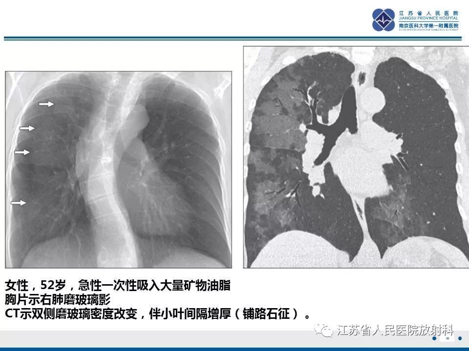 影像PPT - 【PPT】脂质性肺炎-30