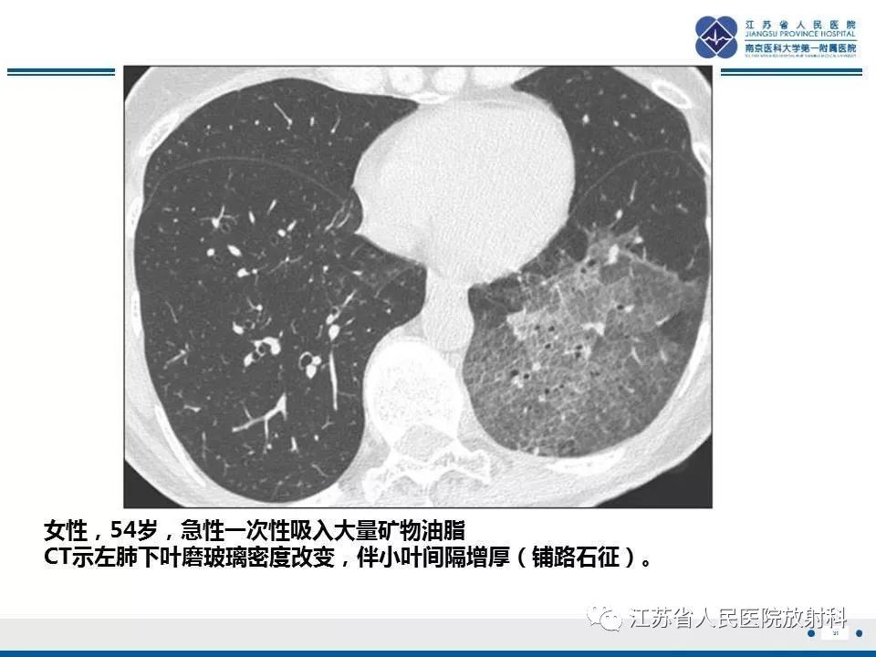 影像PPT - 【PPT】脂质性肺炎-31