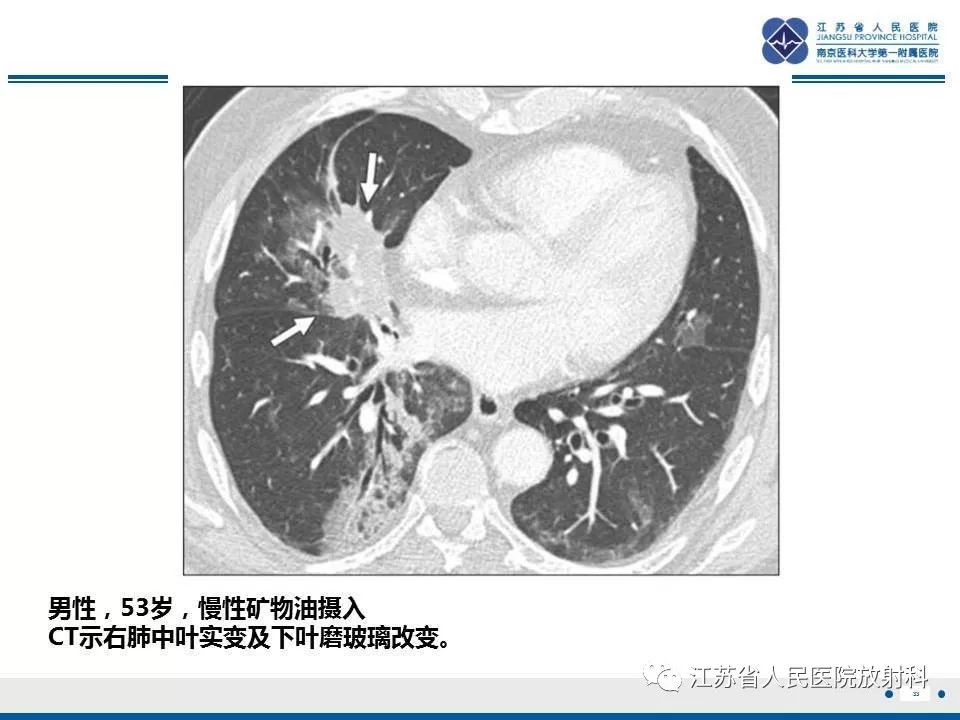 影像PPT - 【PPT】脂质性肺炎-33