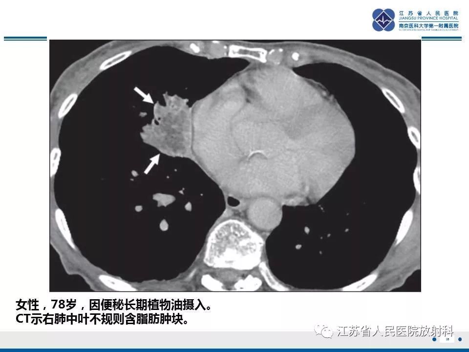 影像PPT - 【PPT】脂质性肺炎-35