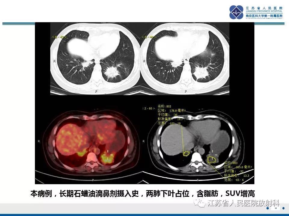 影像PPT - 【PPT】脂质性肺炎-36