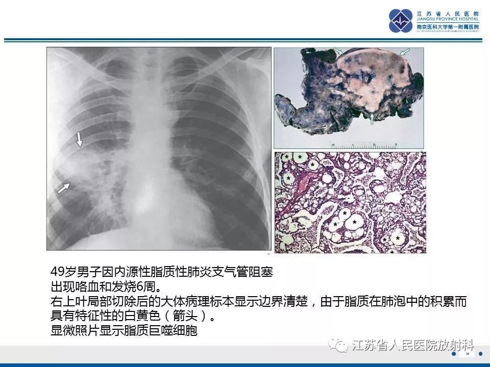 影像PPT - 【PPT】脂质性肺炎-38