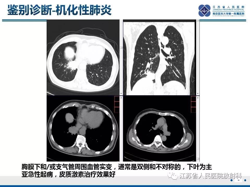 影像PPT - 【PPT】脂质性肺炎-39