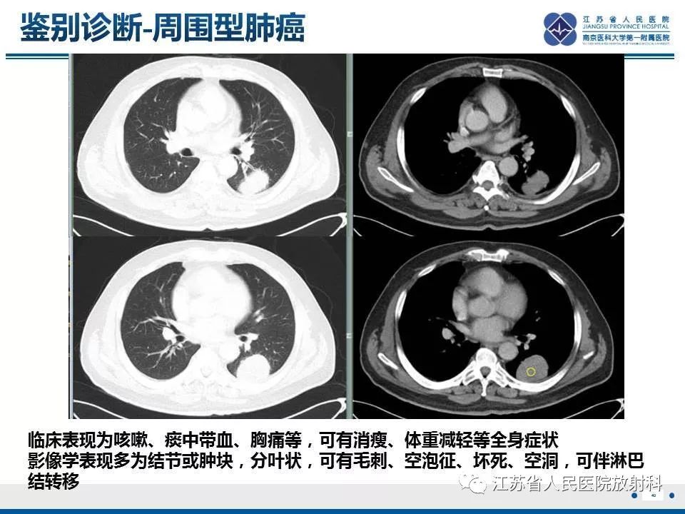 影像PPT - 【PPT】脂质性肺炎-40