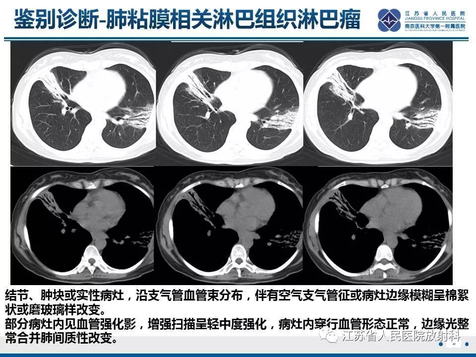 影像PPT - 【PPT】脂质性肺炎-41