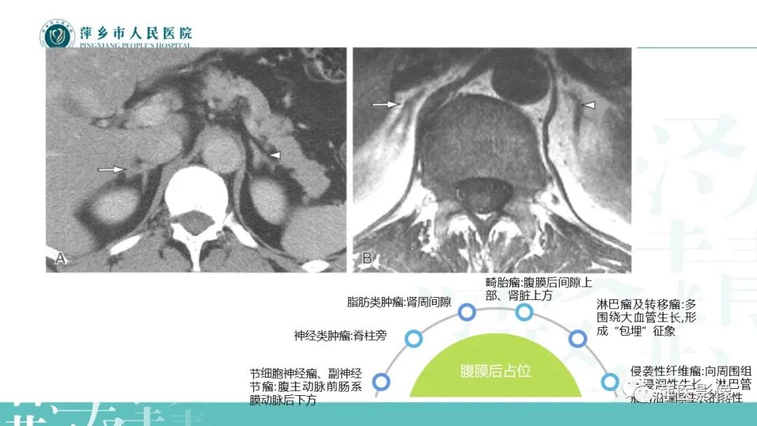 影像PPT - 【PPT】肾上腺嗜铬细胞瘤及肾上腺占位性病变-6