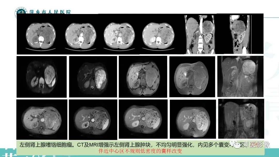 影像PPT - 【PPT】肾上腺嗜铬细胞瘤及肾上腺占位性病变-19