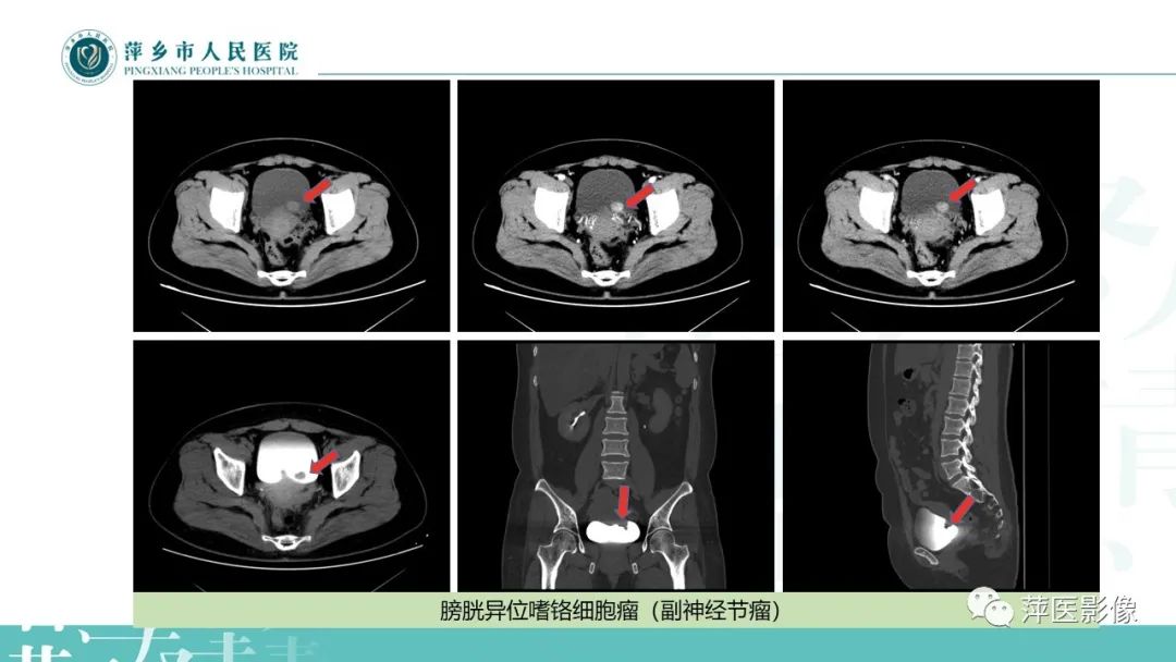 影像PPT - 【PPT】肾上腺嗜铬细胞瘤及肾上腺占位性病变-20